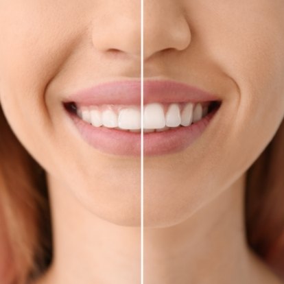 Close up of person smiling before and after gummy smile correction