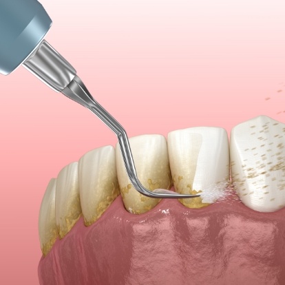 Illustrated dental instrument clearing plaque from teeth during gum disease treatment