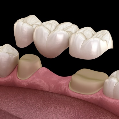 Illustrated dental bridge replacing a missing tooth