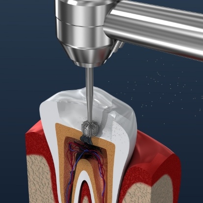 Illustrated dental instrument cleaning inside of tooth during root canal treatment