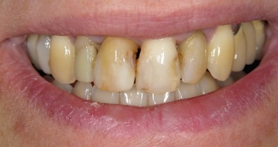 Close up of smile with yellow damaged teeth