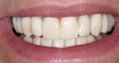 Close up of improved smile after dental treatment