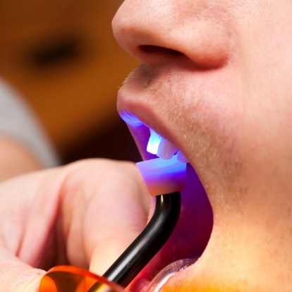 Close up of dental patient getting cosmetic bonding on front upper tooth