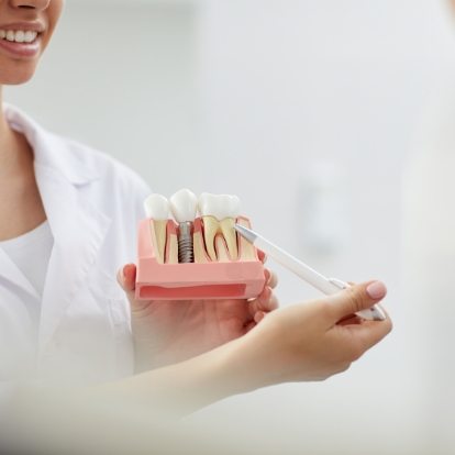 Dentist holding a model of a dental implant
