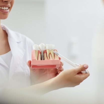 Dentist holding a model of a dental implant