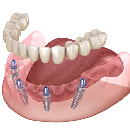 a 3D illustration of implant dentures being placed