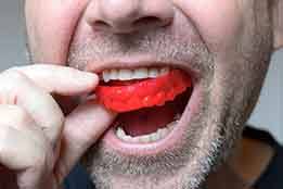 Protect your dental implants with a sports mouthguard if you’re an athelete