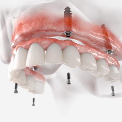 Illustration of implant dentures in Mercerville 