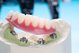Close-up of fixed implant denture model 