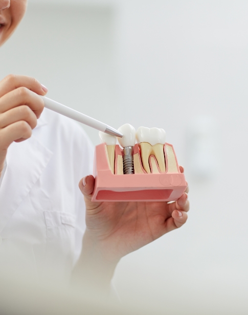 Dentist showing a patient a dental implant model