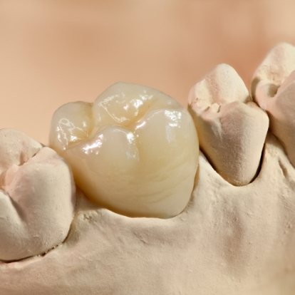 White dental crown over a tooth in a model of the mouth