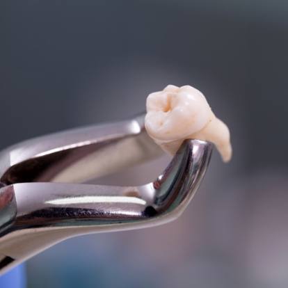 Dental forceps holding an extracted tooth