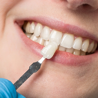 a veneer against a tooth